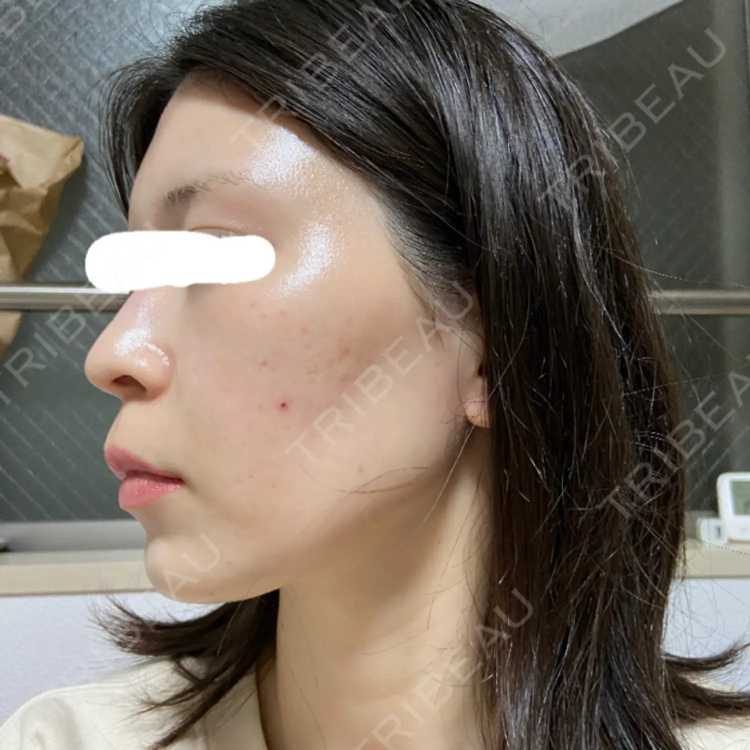 施術前の写真
