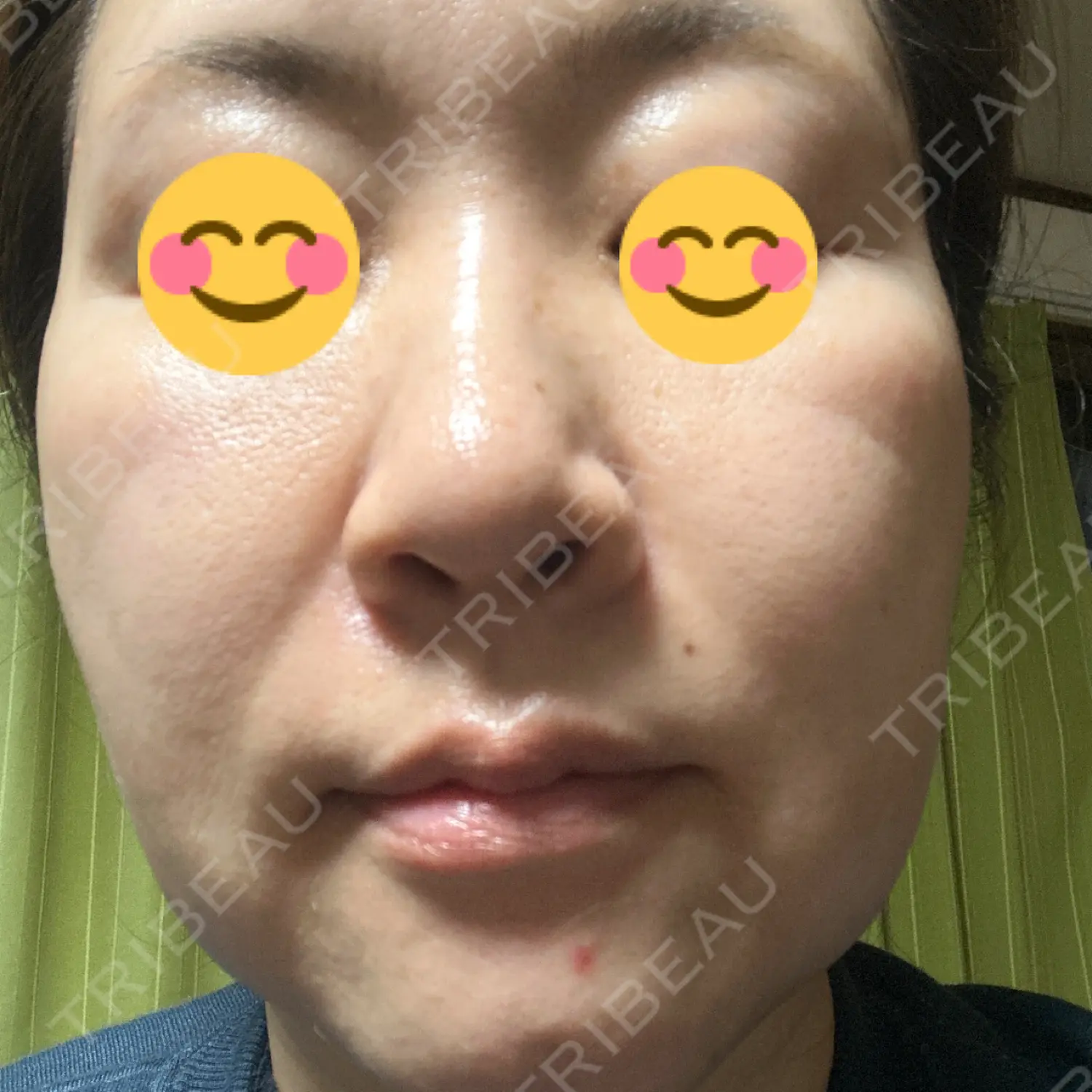 施術前の写真