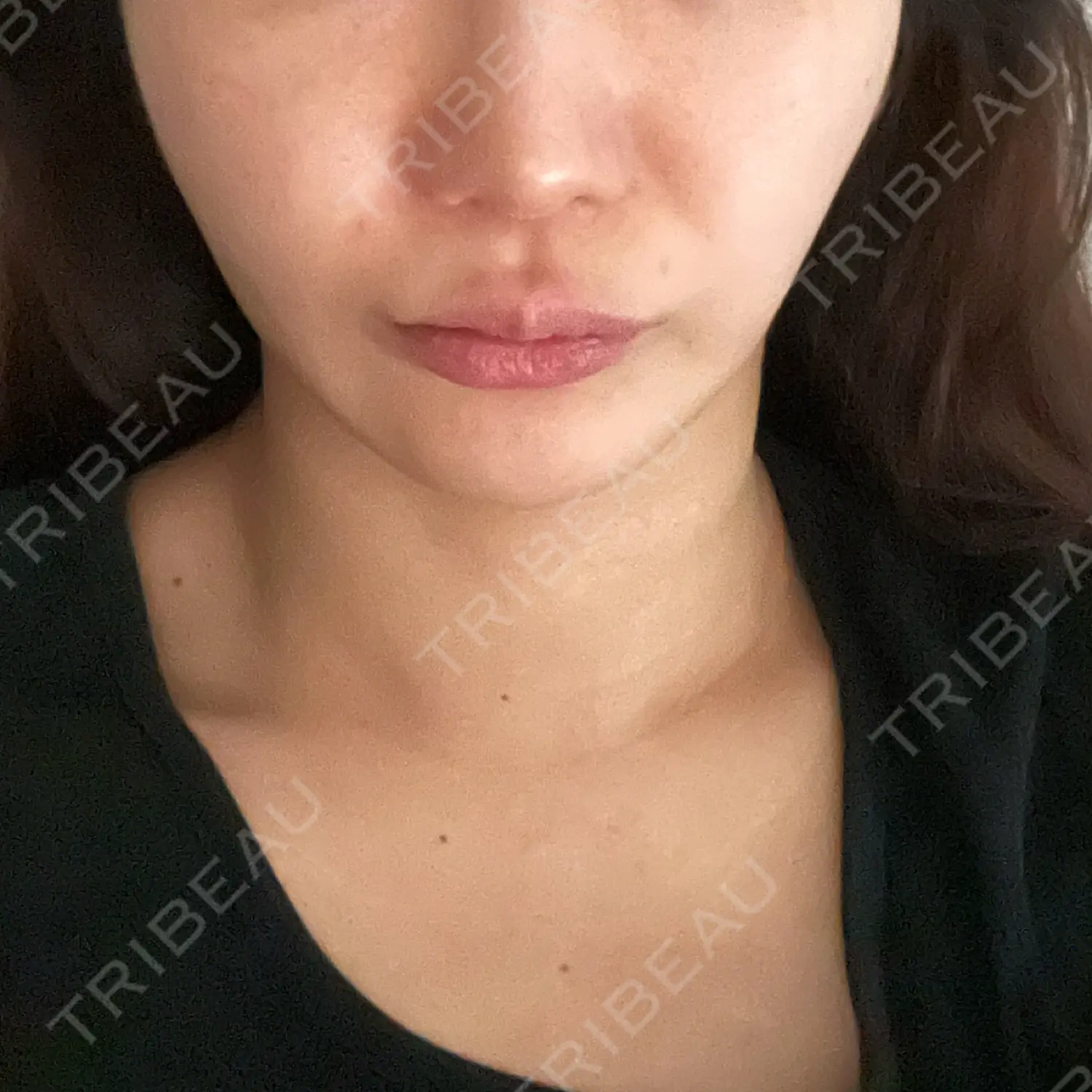 施術前の写真
