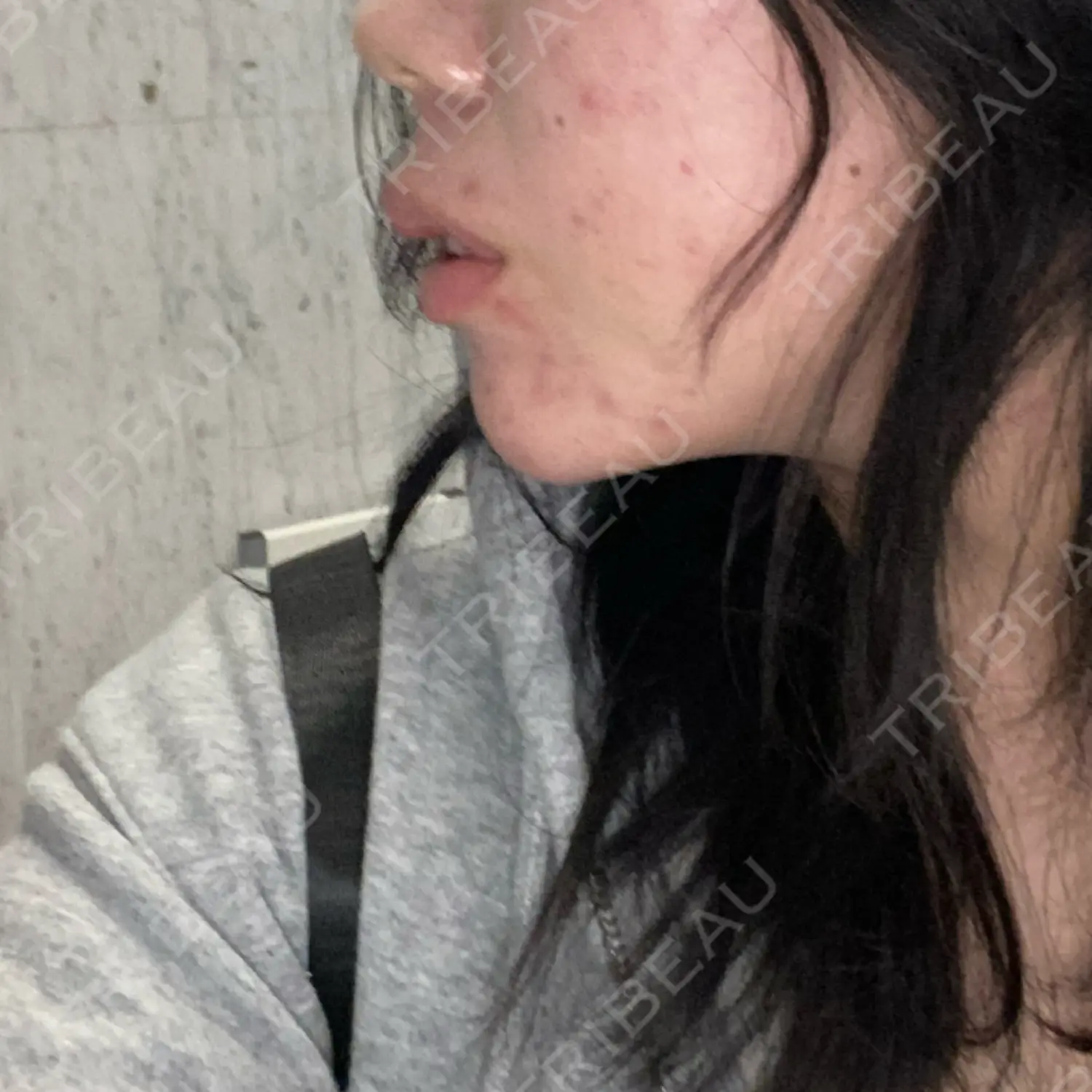 施術前の写真