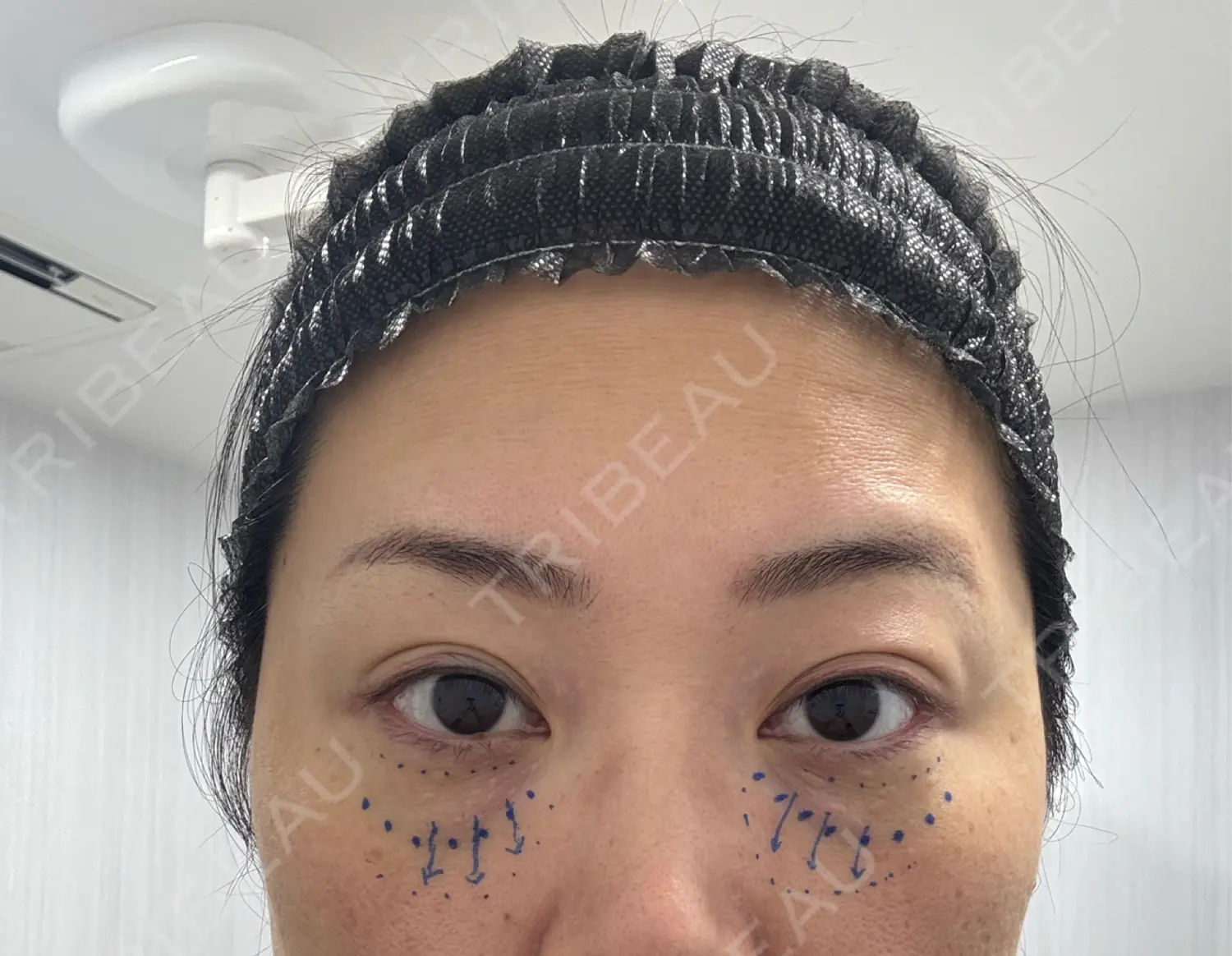 施術前の写真