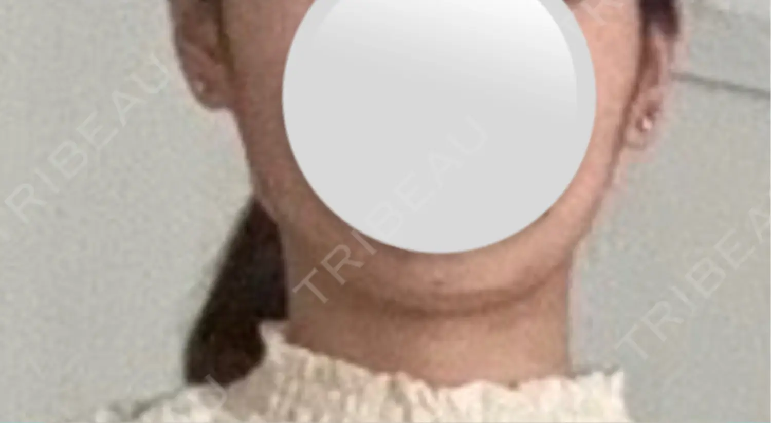 施術前の写真