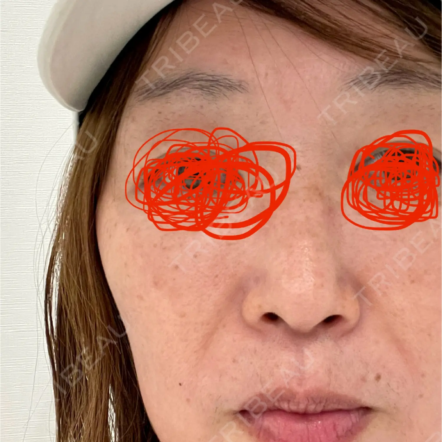 施術前の写真