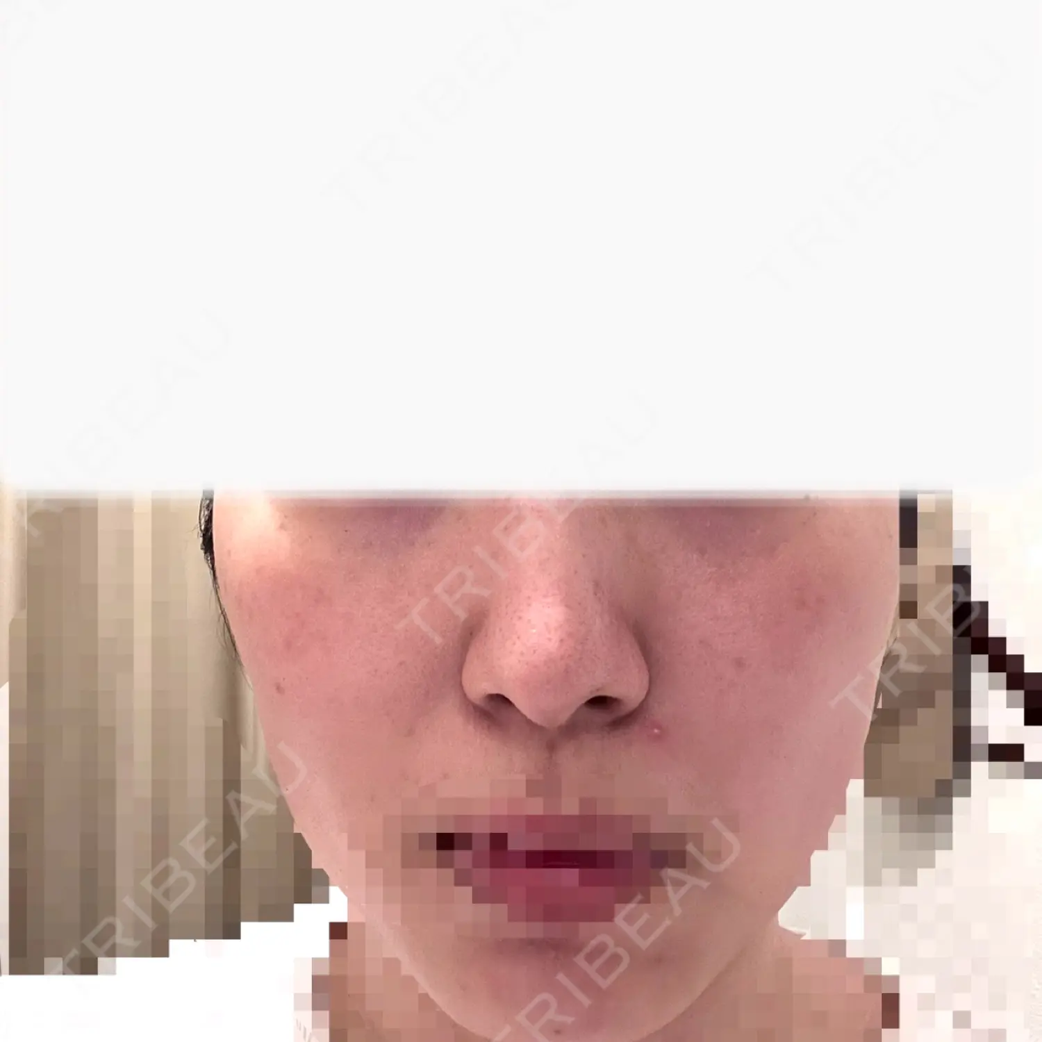 施術前の写真