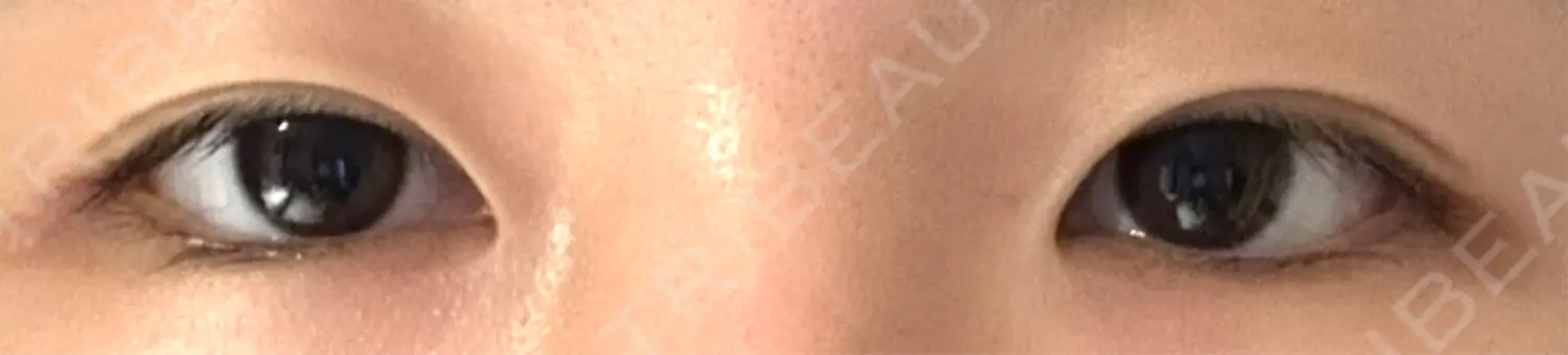施術前の写真