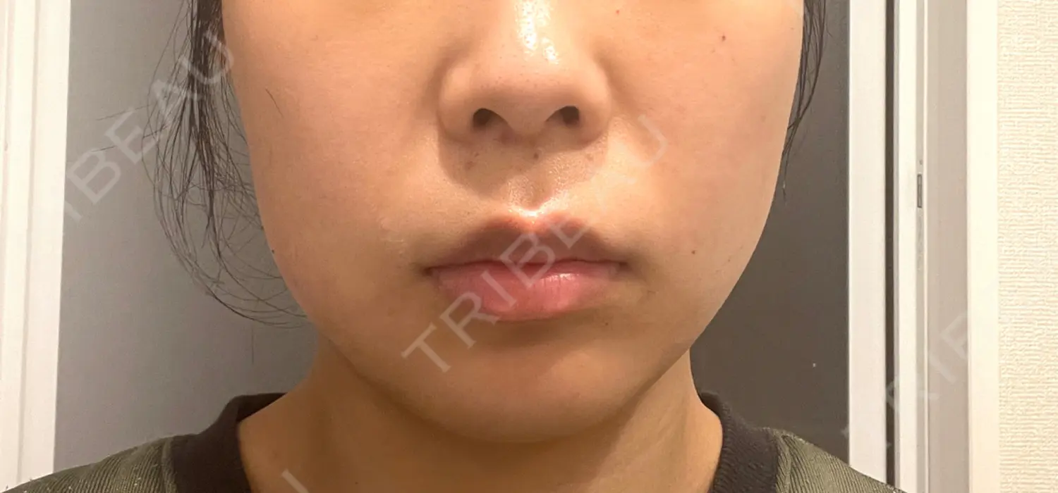 施術前の写真