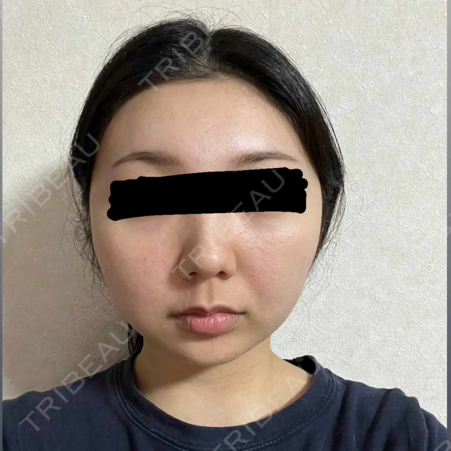 施術前の写真