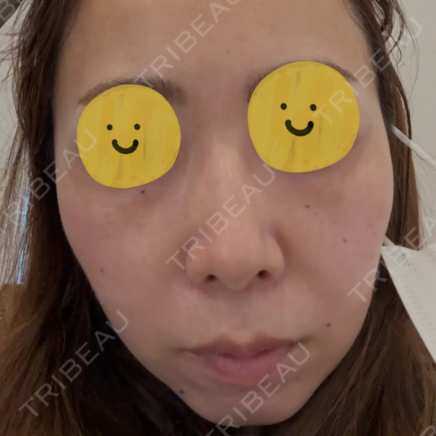 施術前の写真