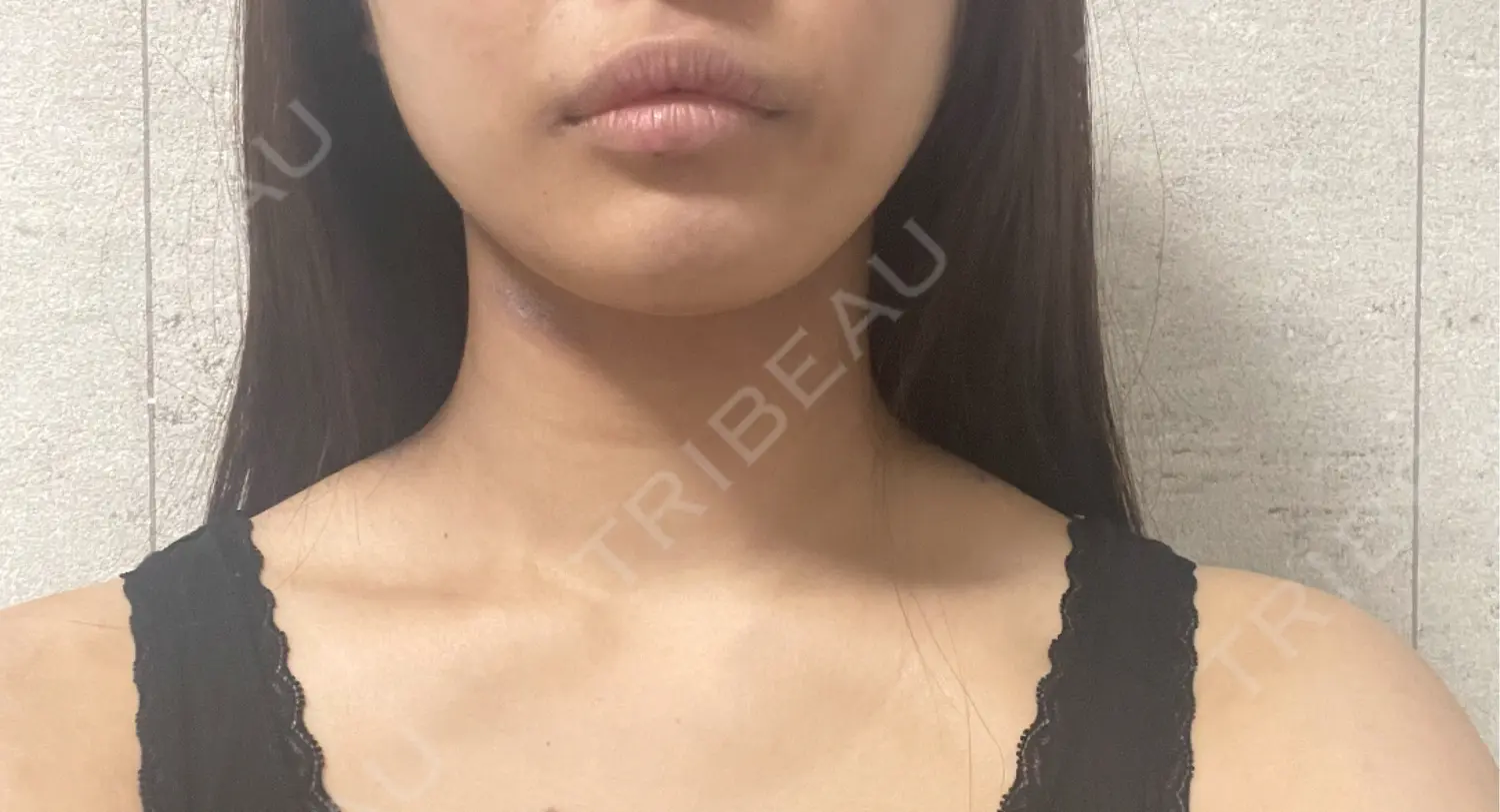 施術前の写真