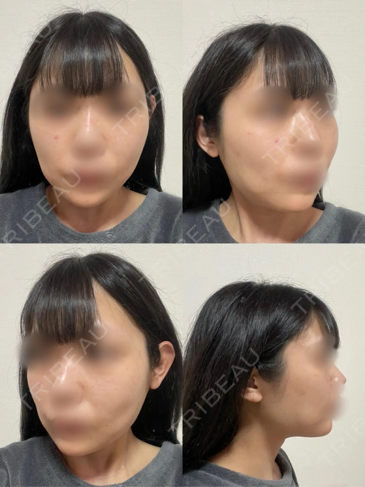 施術前の写真
