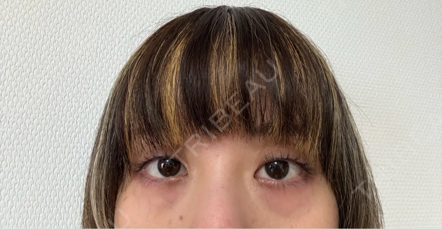 施術前の写真