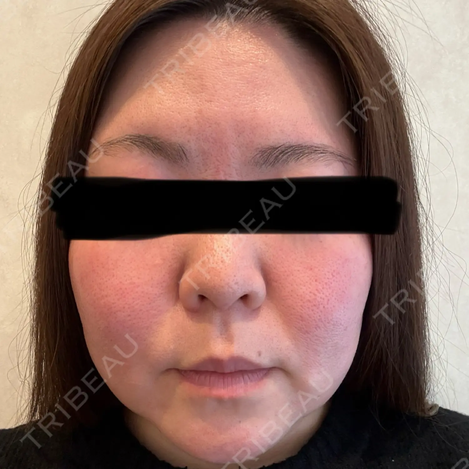 施術前の写真