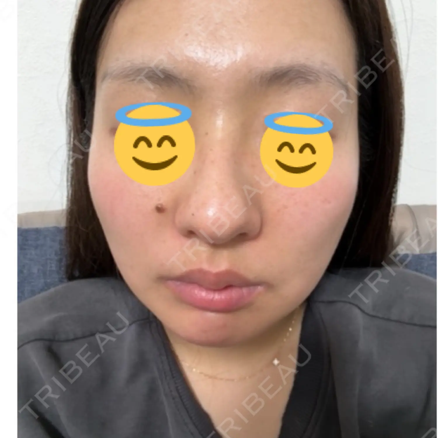 施術前の写真