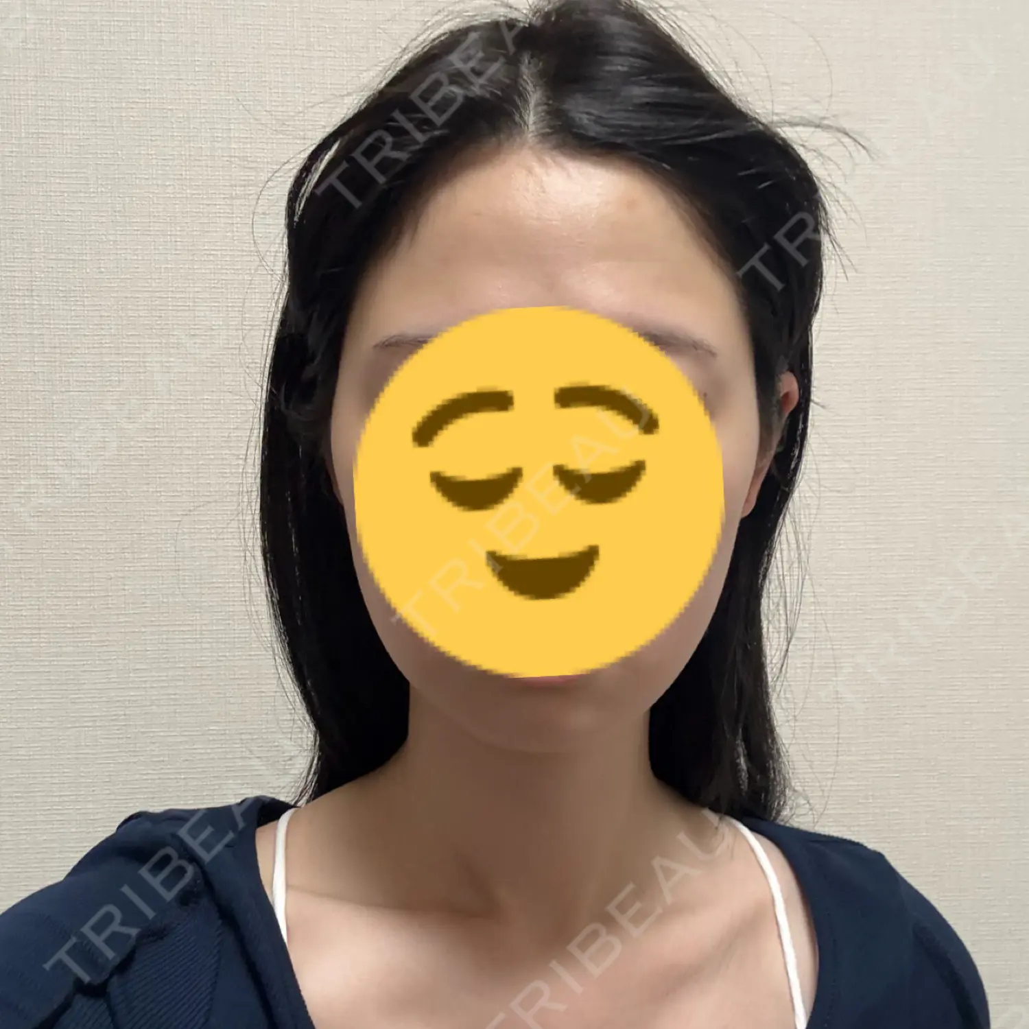 施術前の写真