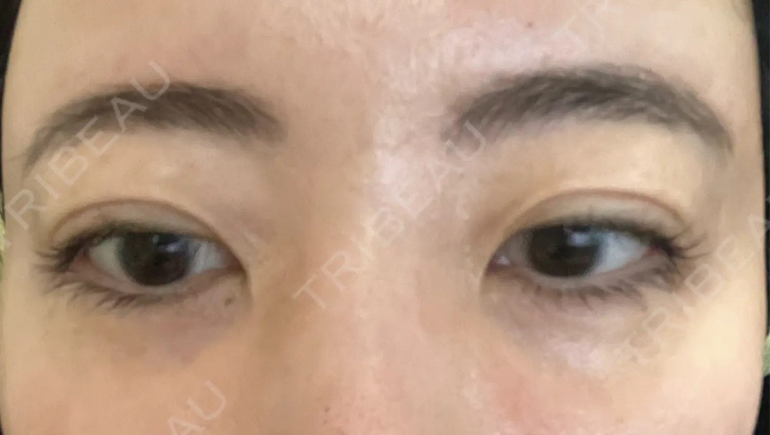 施術前の写真