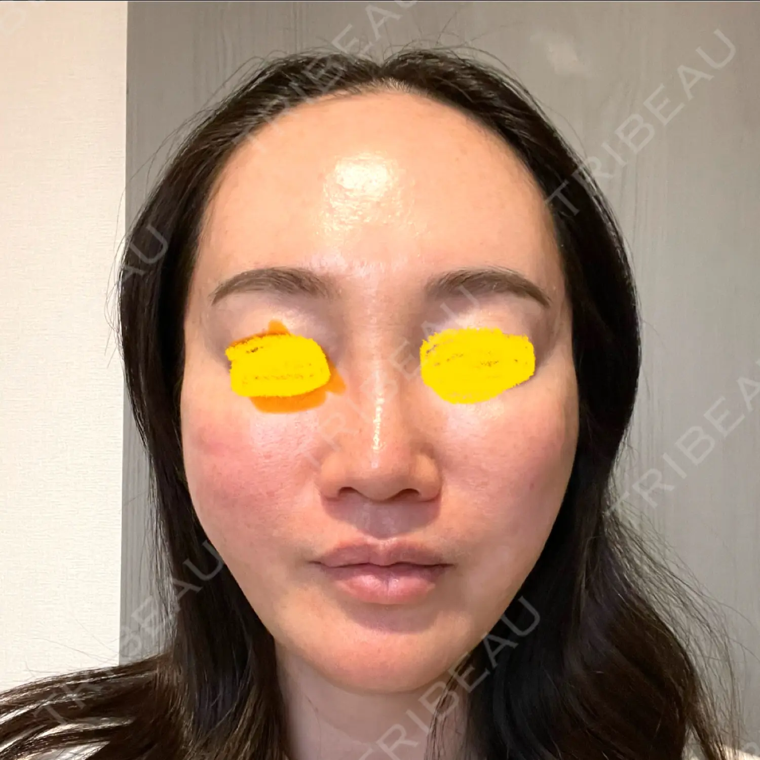 施術前の写真