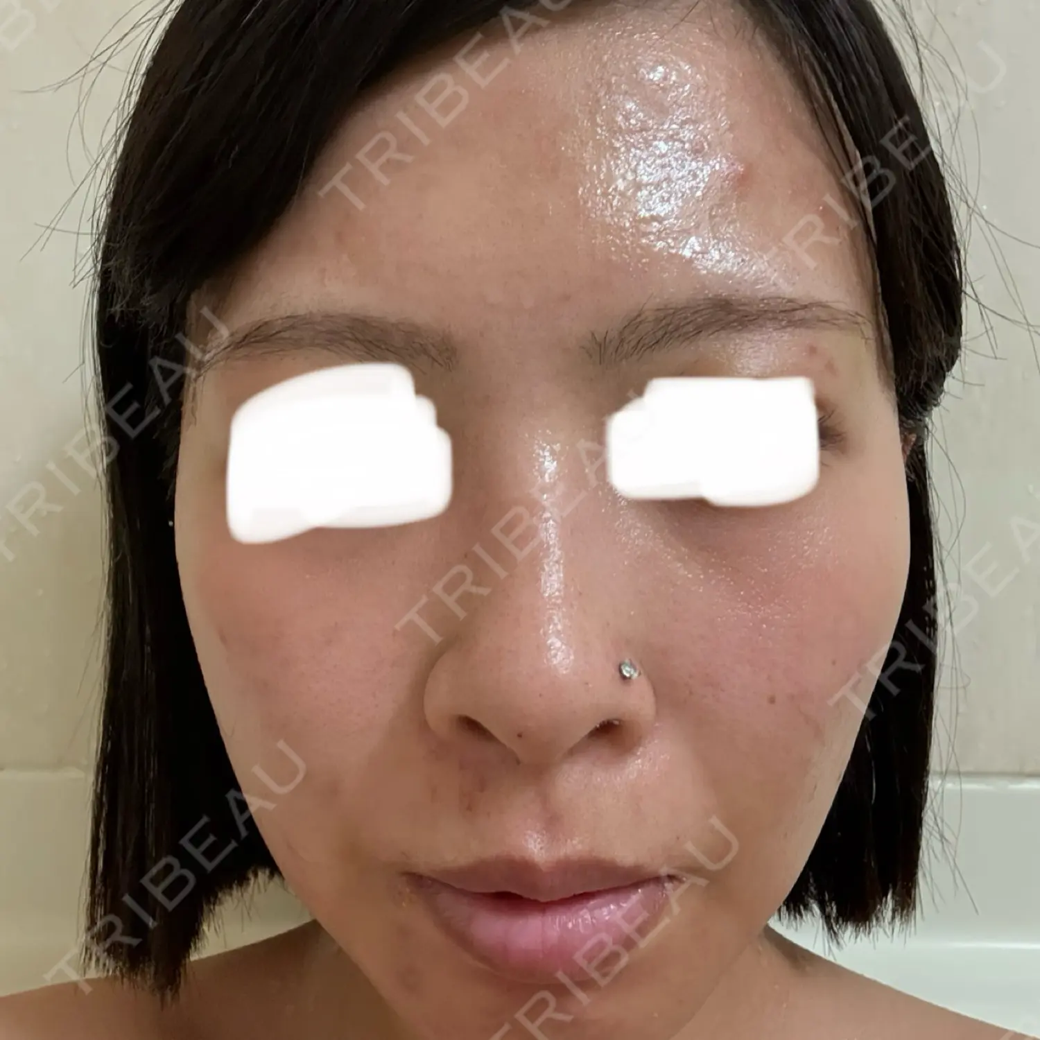 施術前の写真