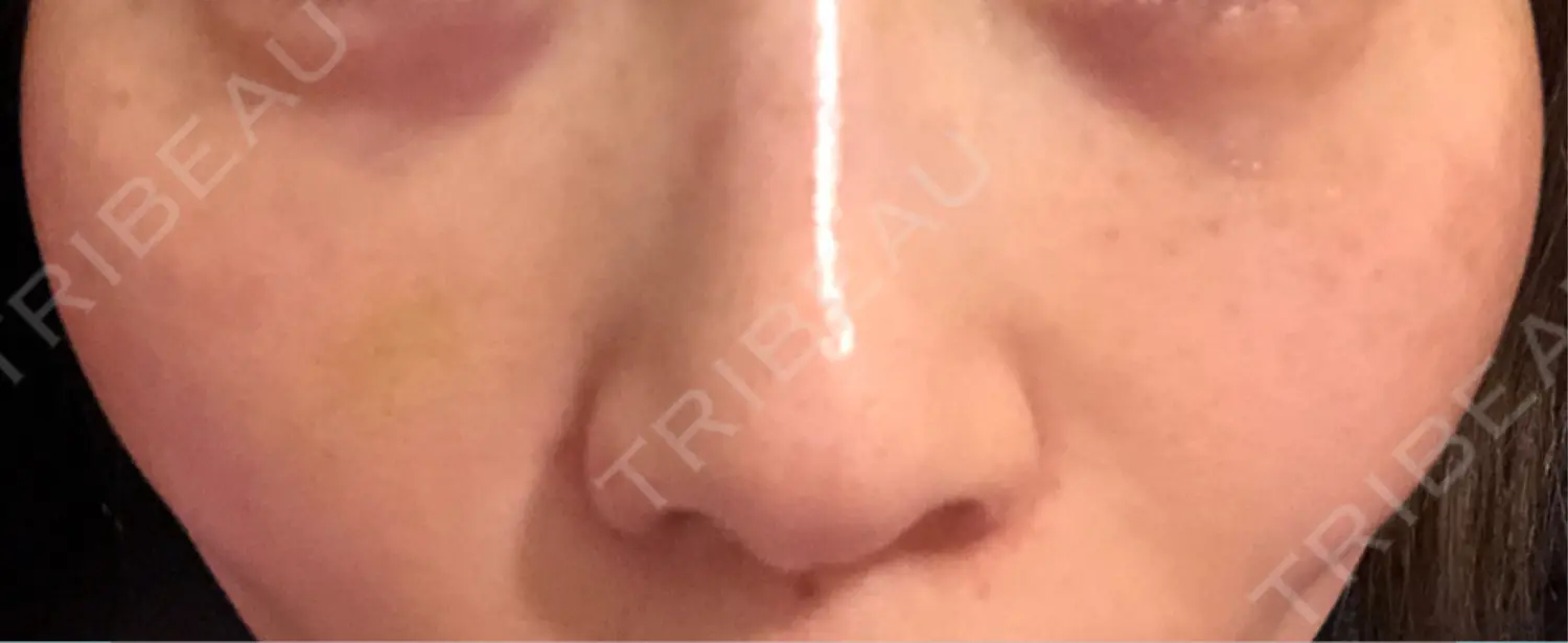 施術前の写真