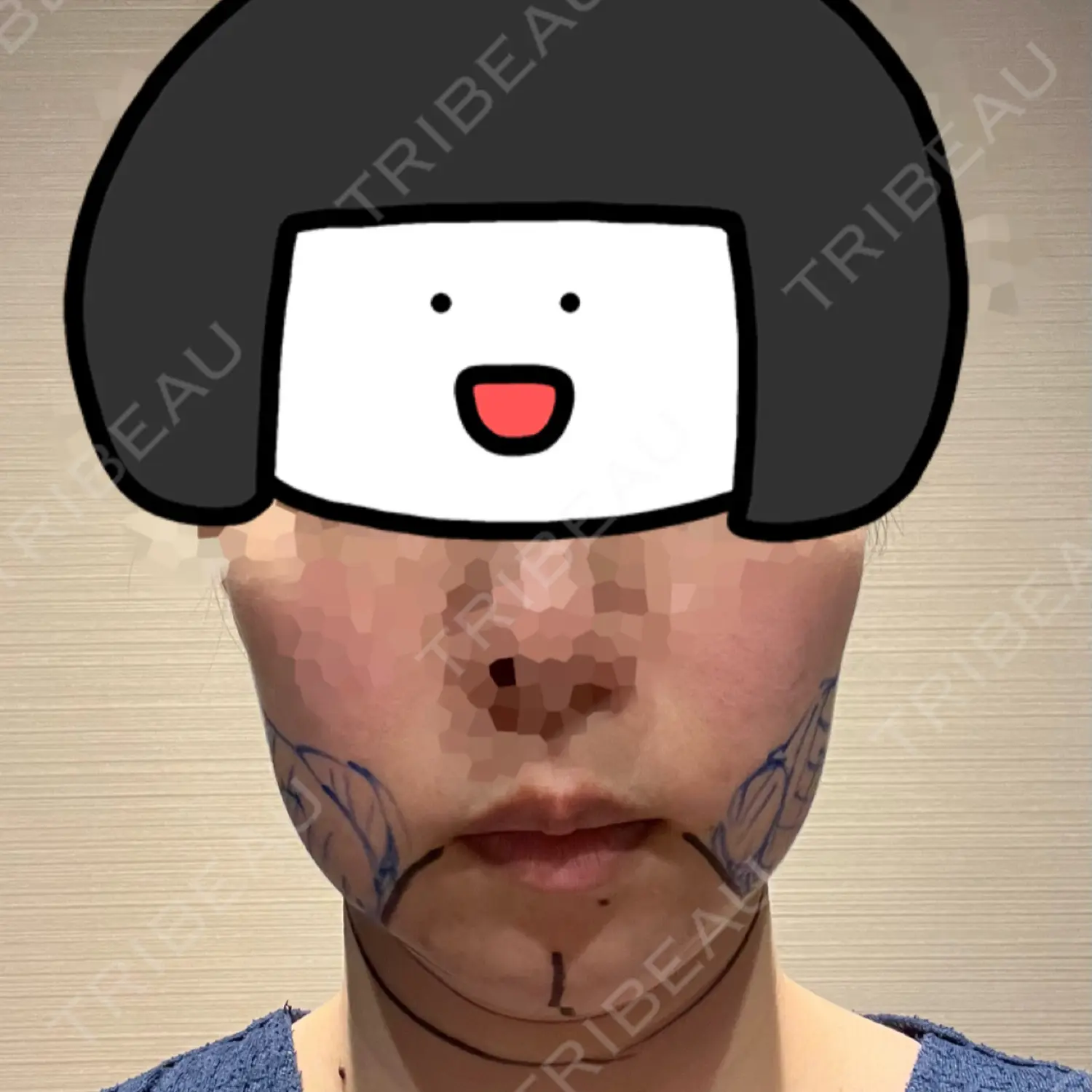 施術前の写真