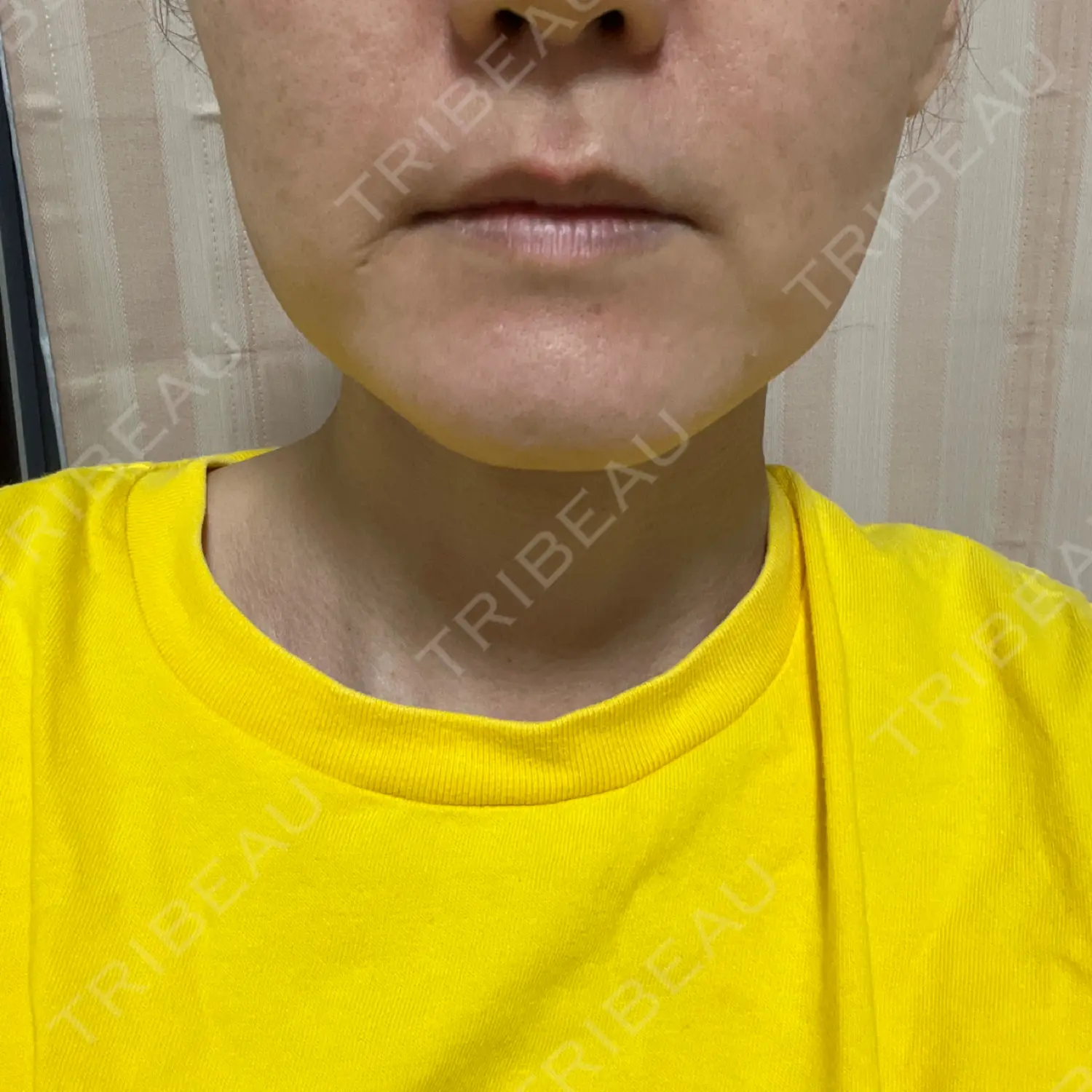 施術前の写真