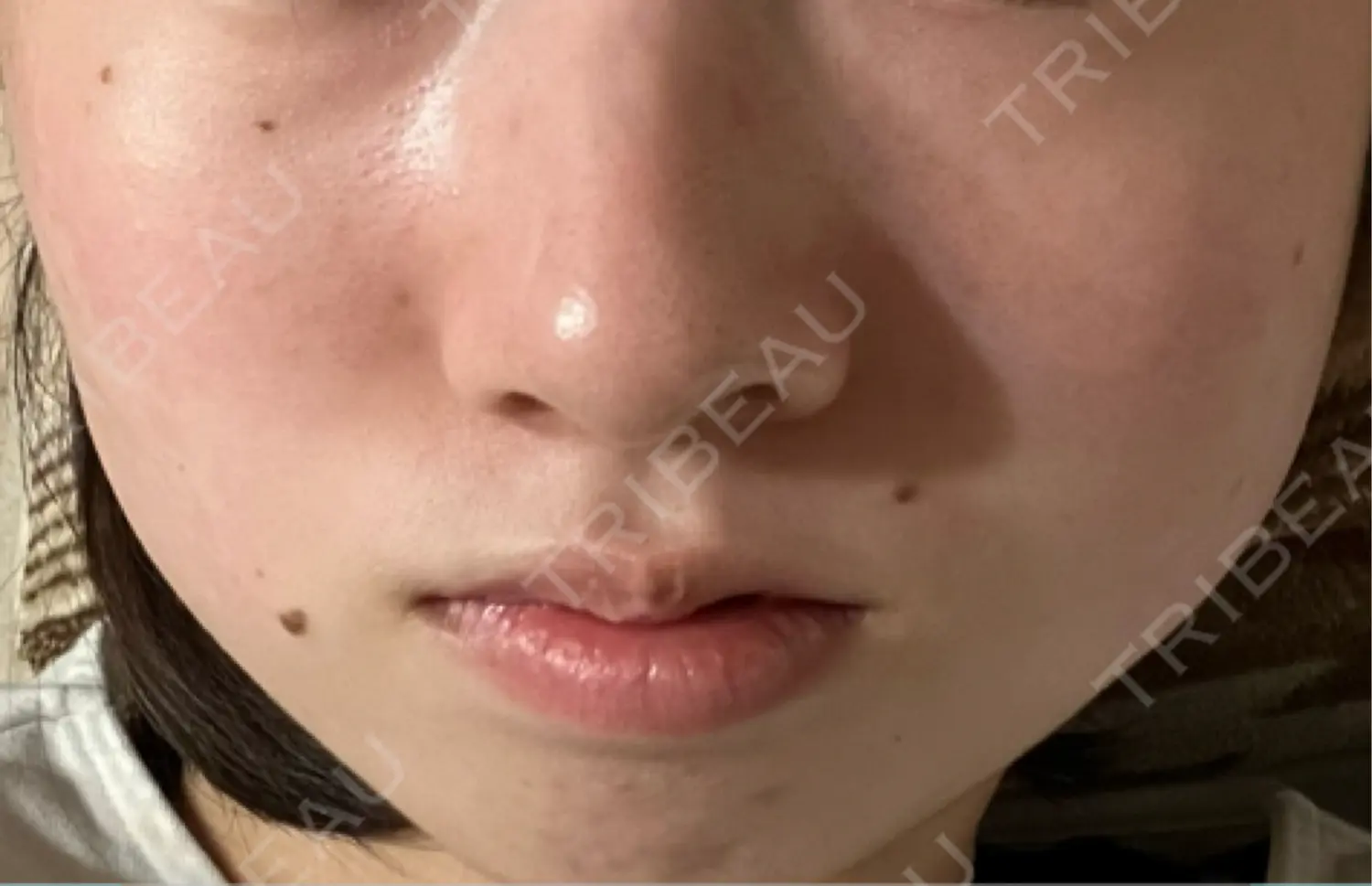 施術前の写真