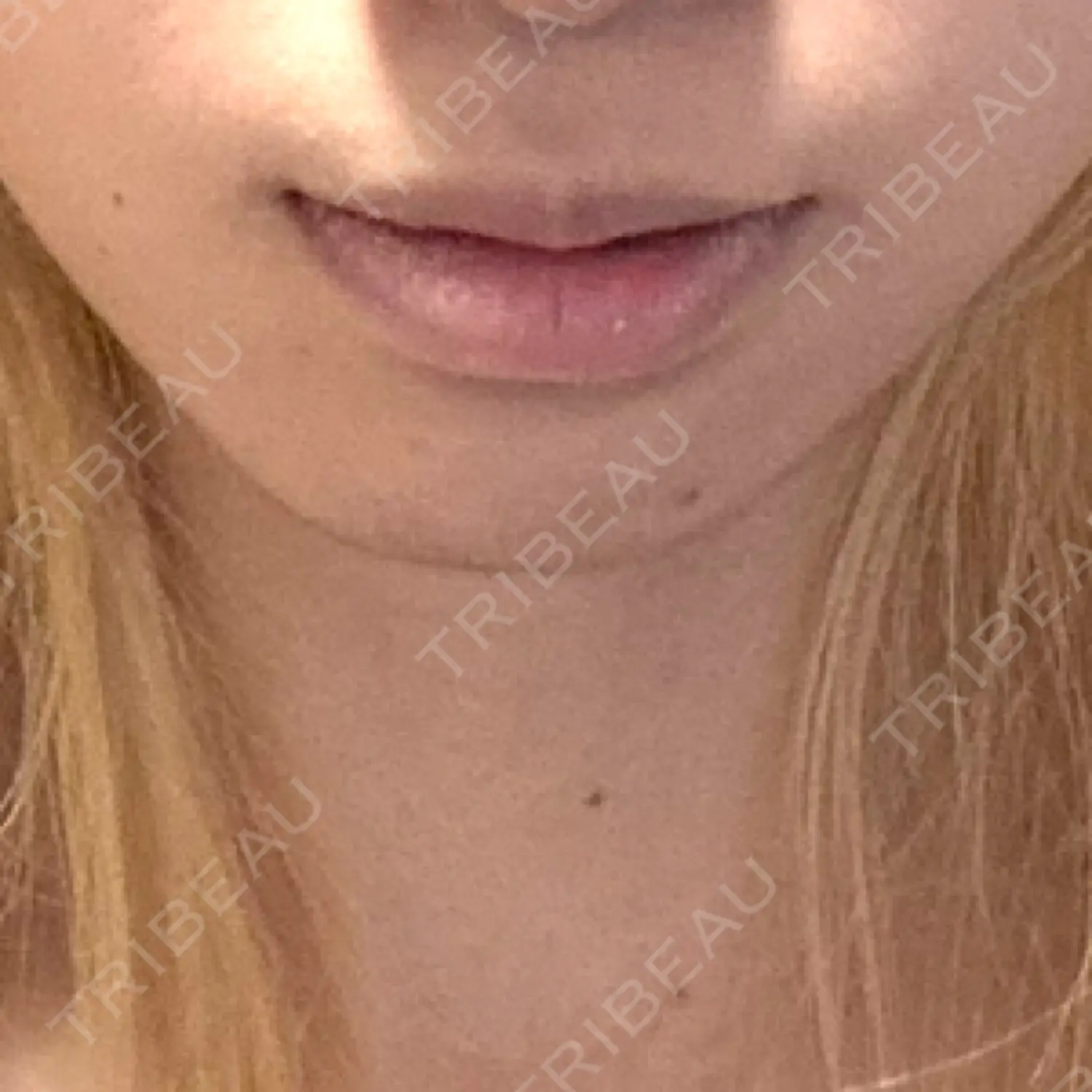 施術前の写真