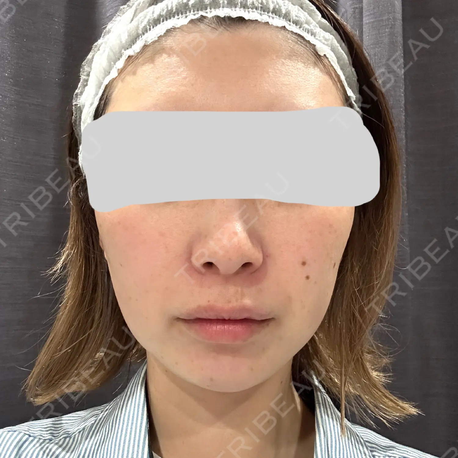 施術前の写真