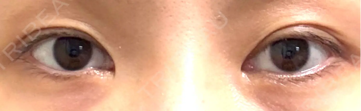 施術前の写真