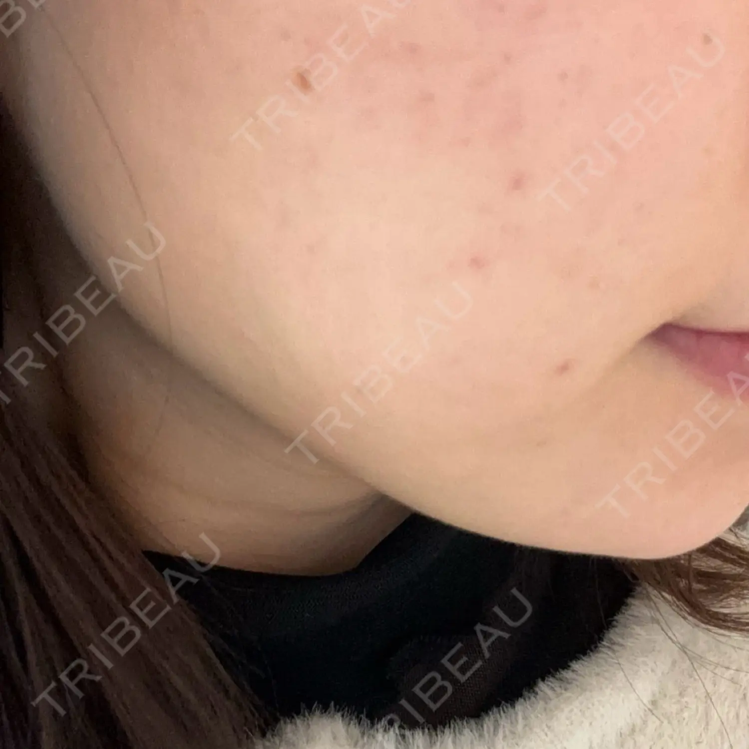 施術前の写真