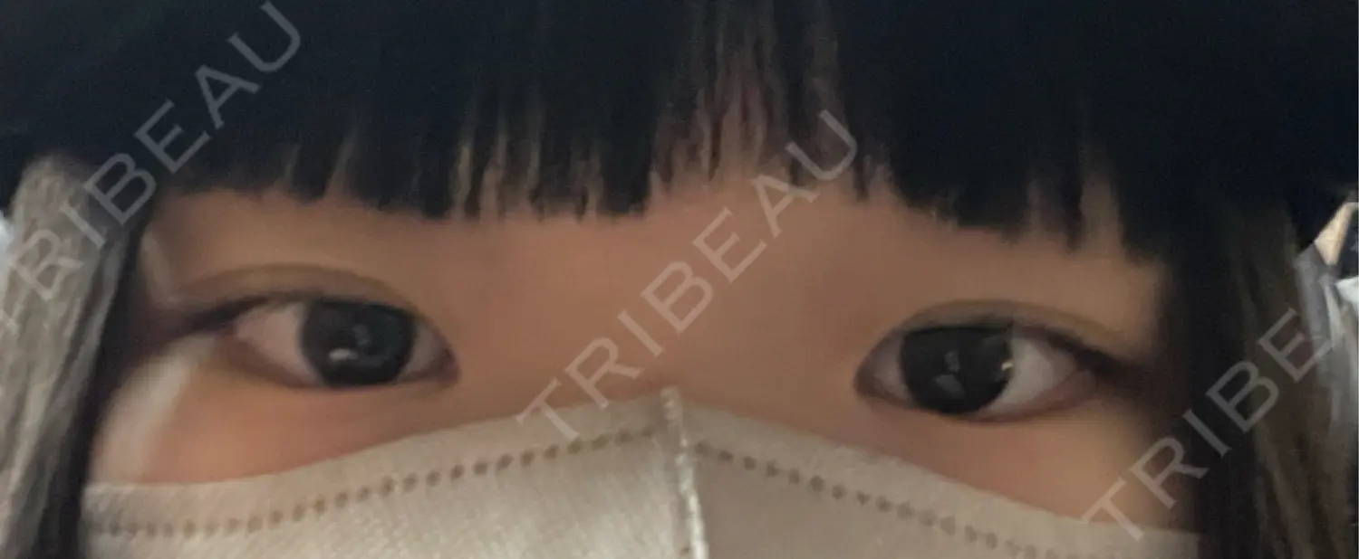 施術前の写真