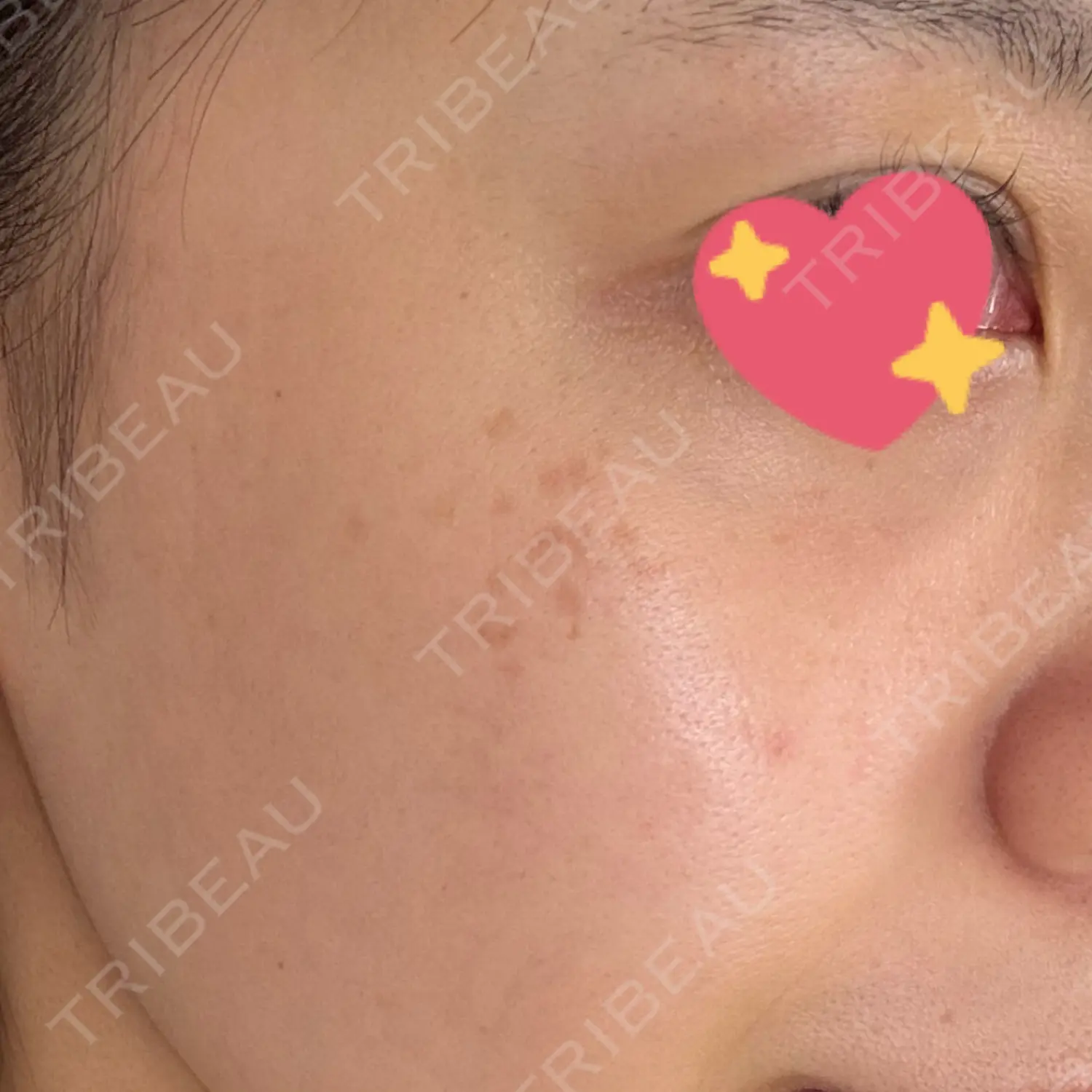 施術前の写真