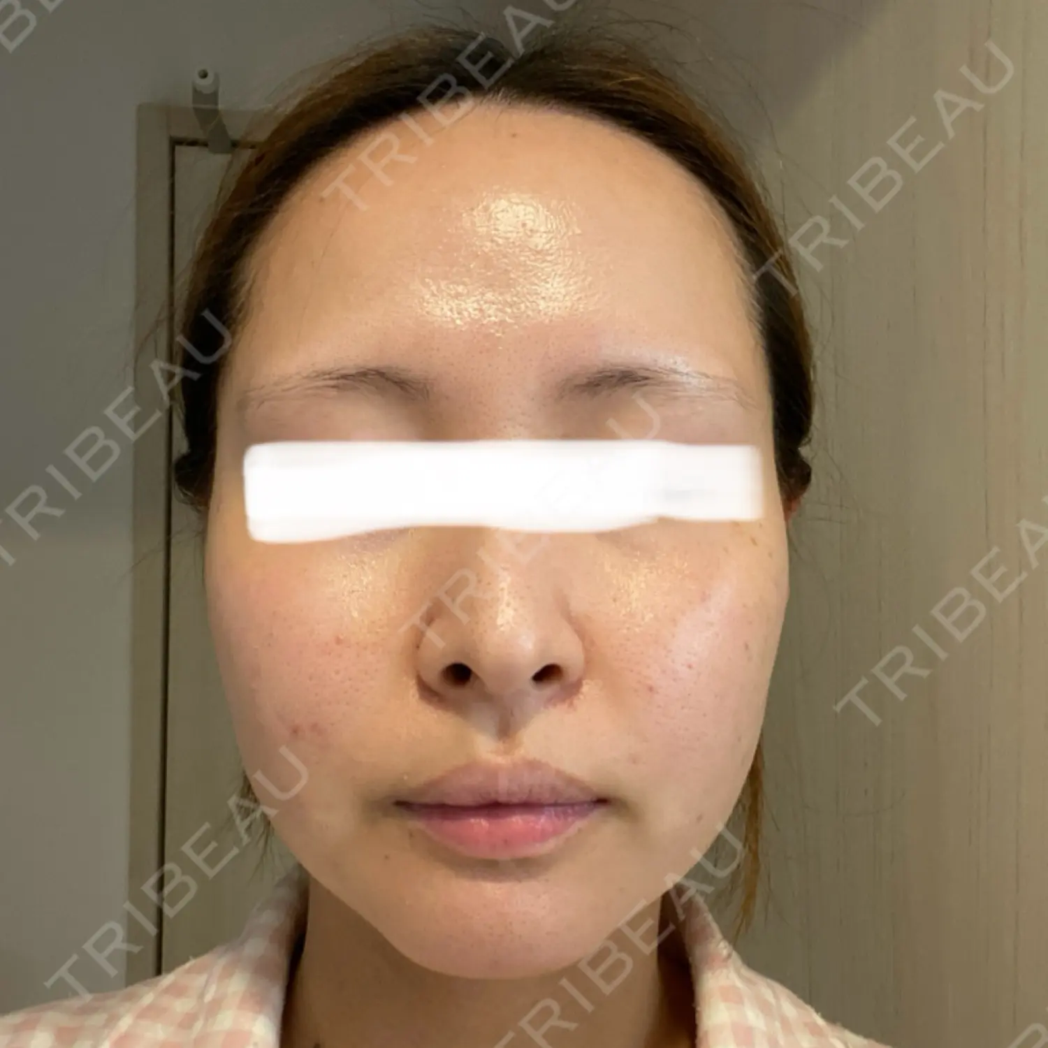 施術前の写真