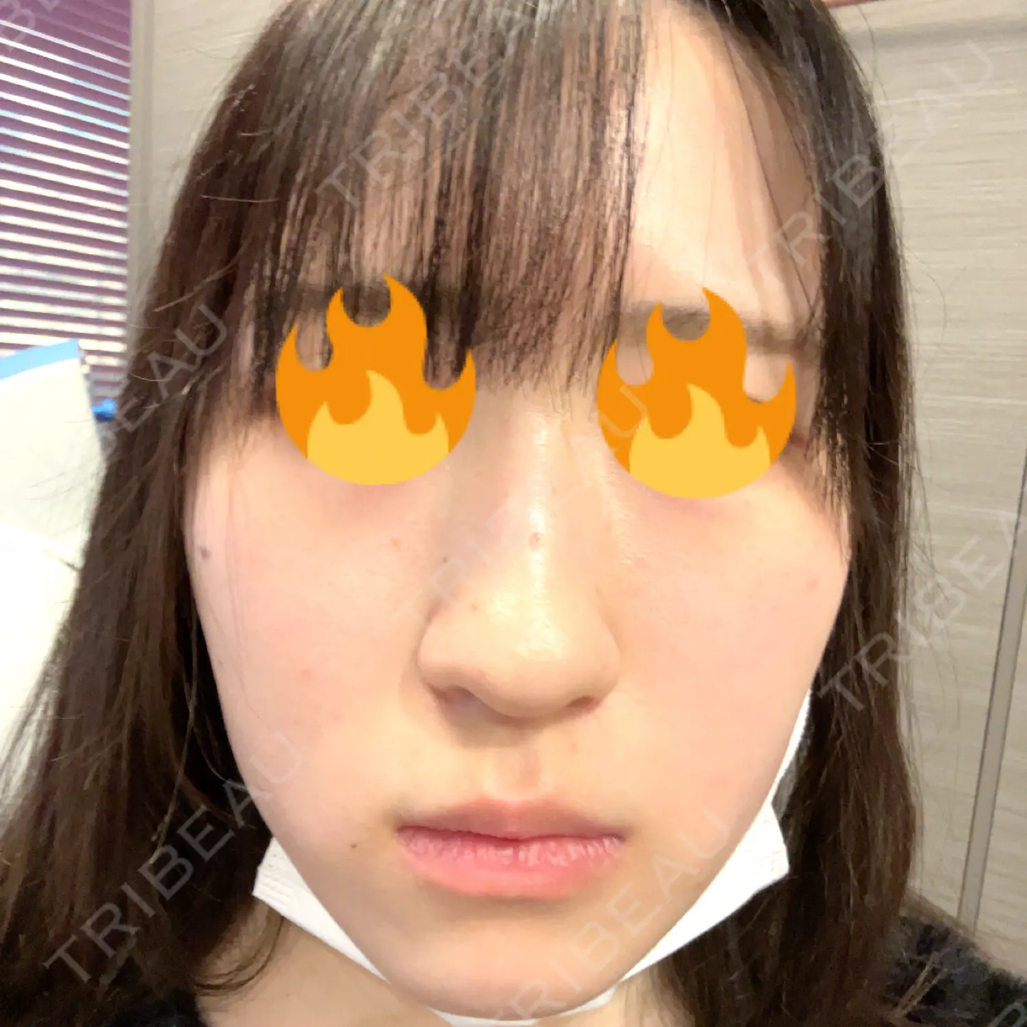 施術前の写真