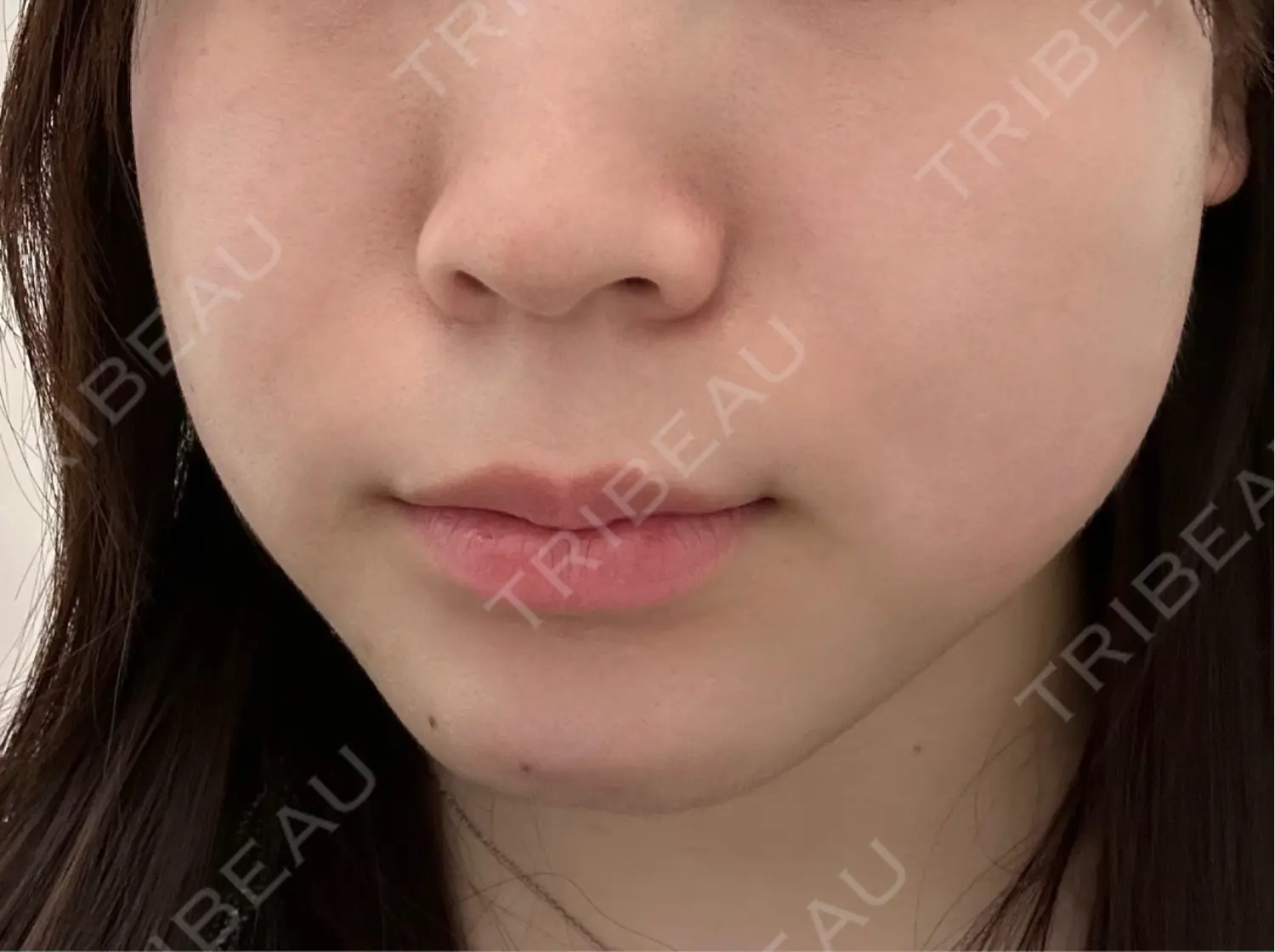 施術前の写真