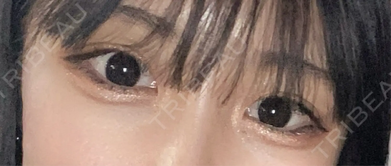 施術前の写真
