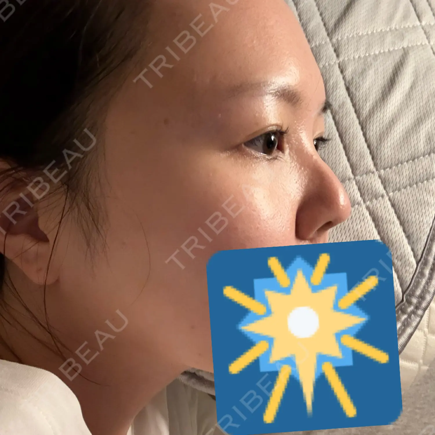 施術前の写真