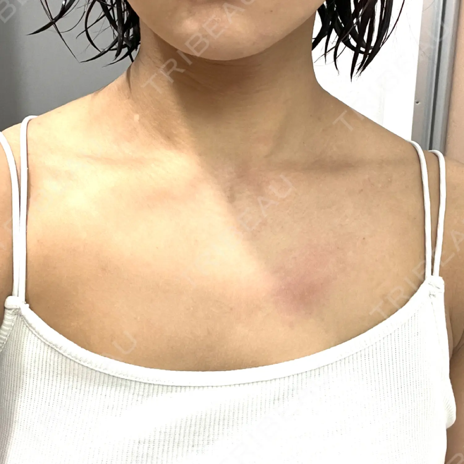 施術前の写真