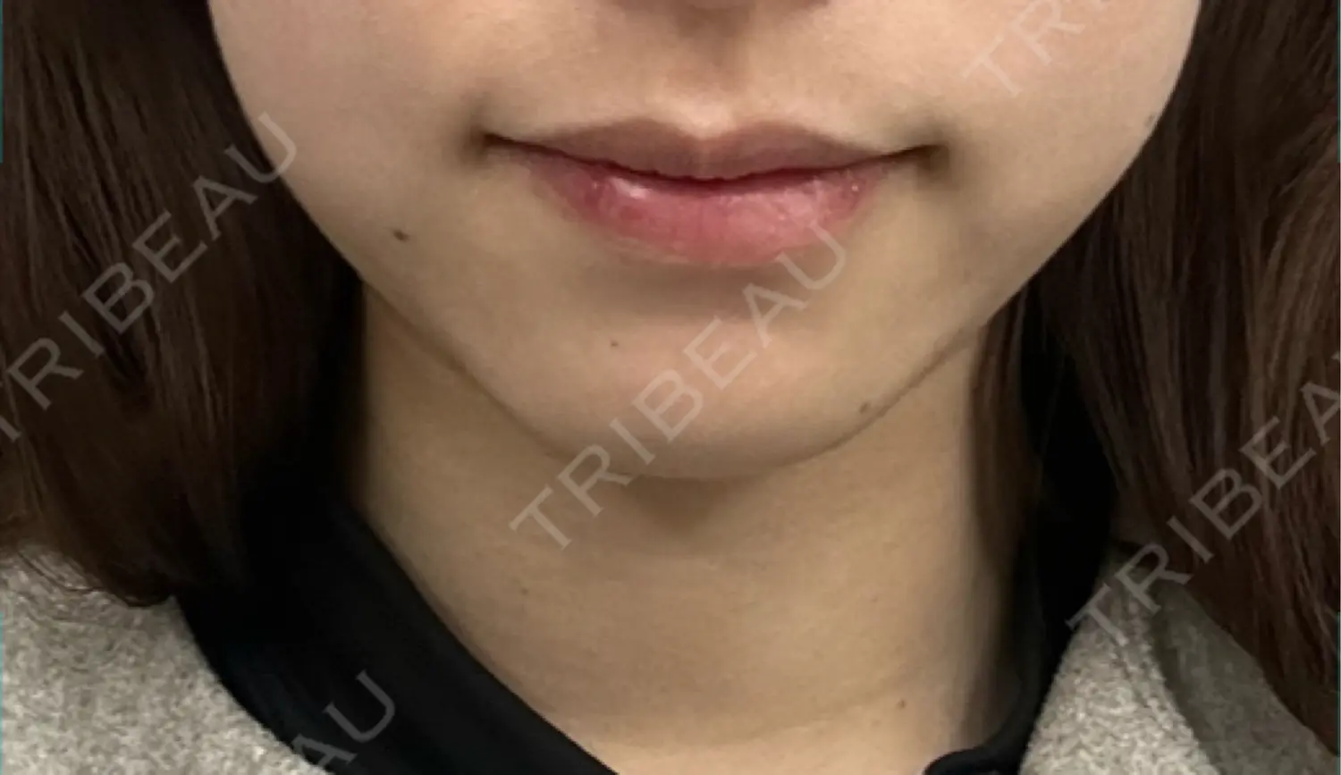 施術前の写真