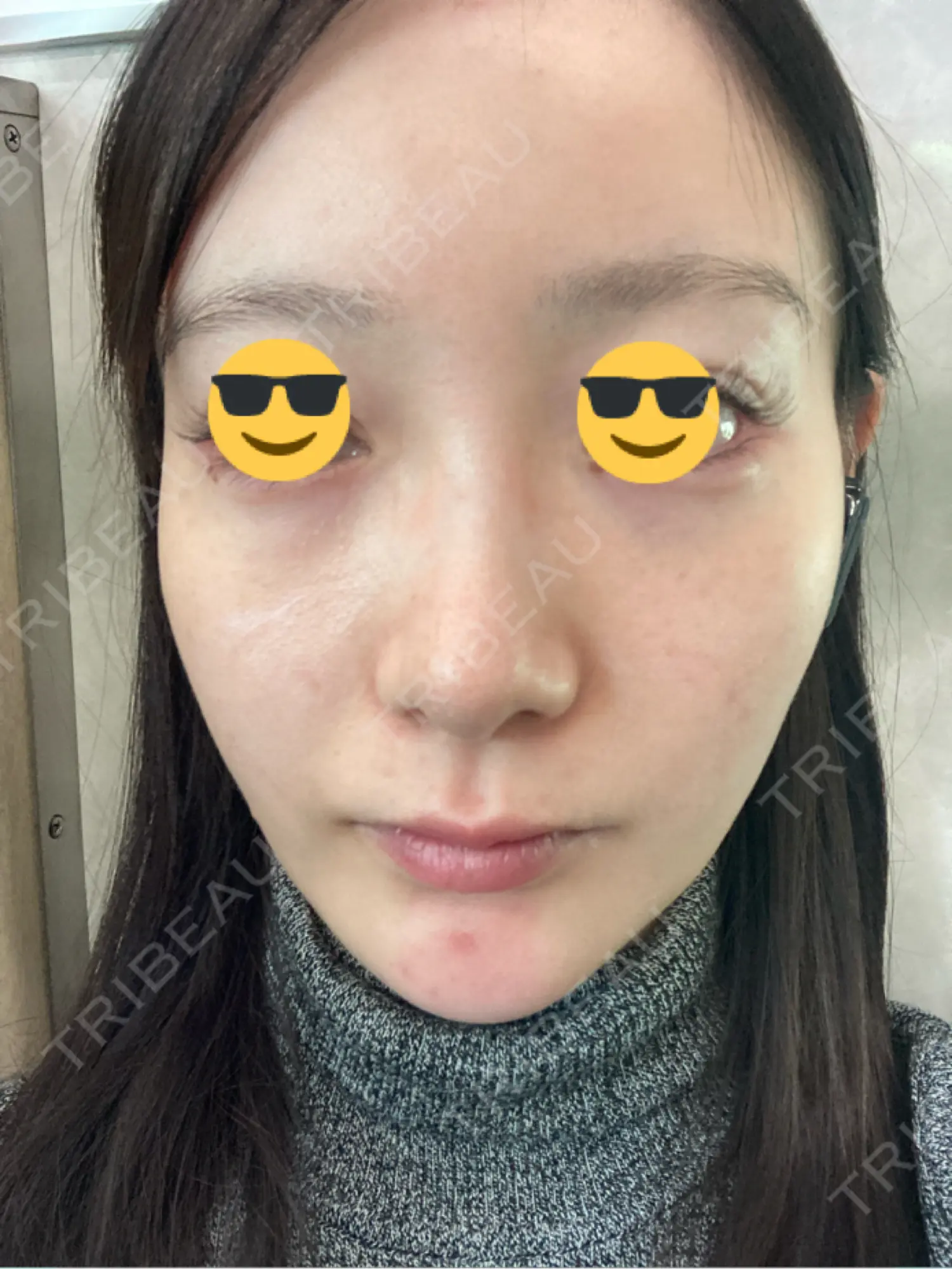 施術前の写真