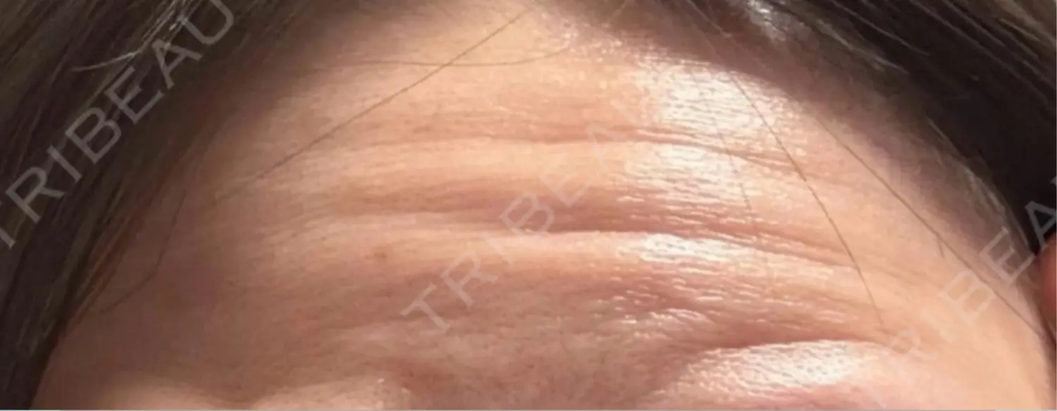 施術前の写真