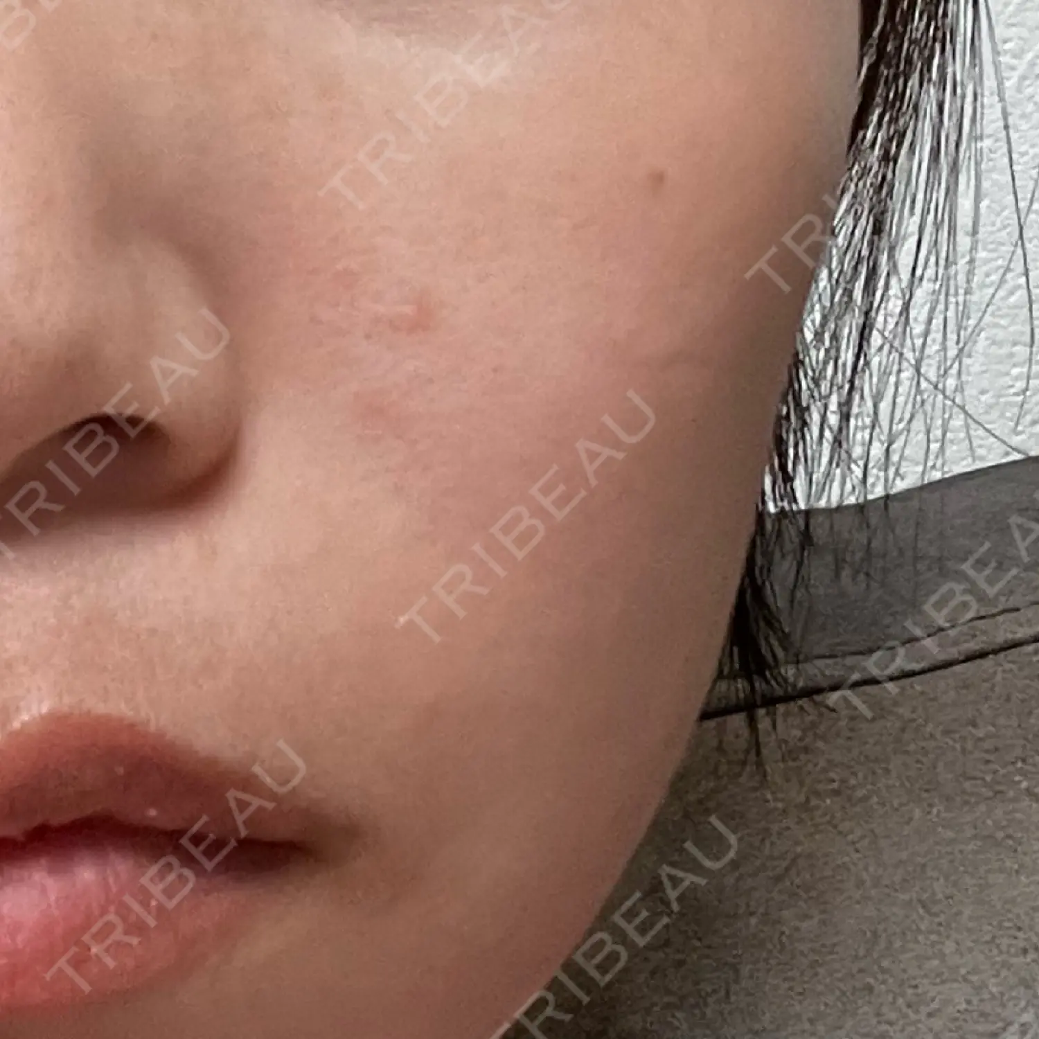施術前の写真