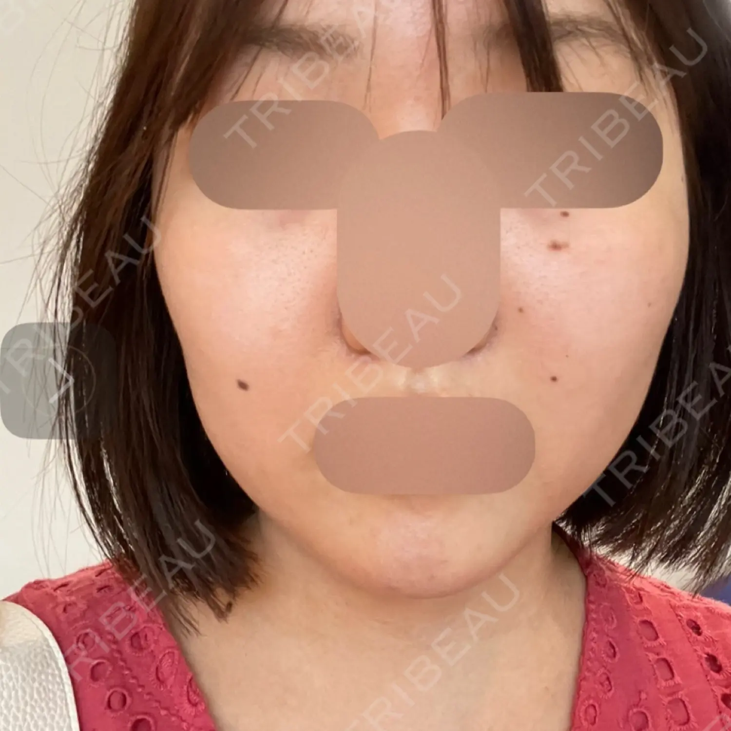 施術前の写真