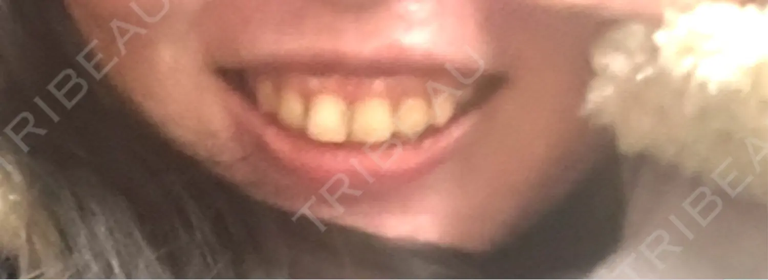 施術前の写真