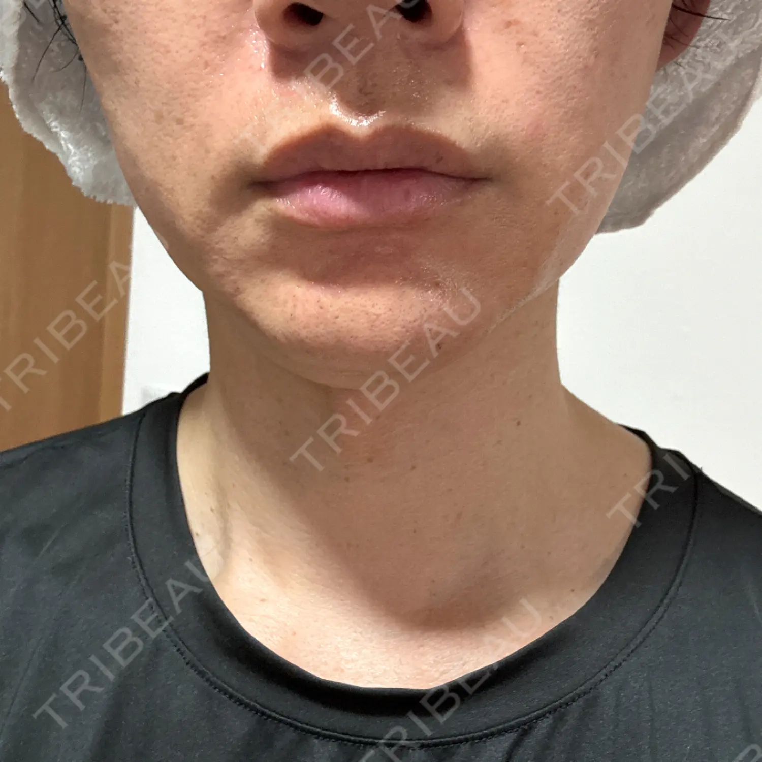 施術前の写真