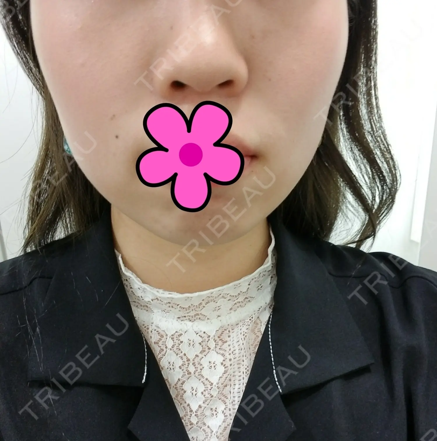 施術前の写真