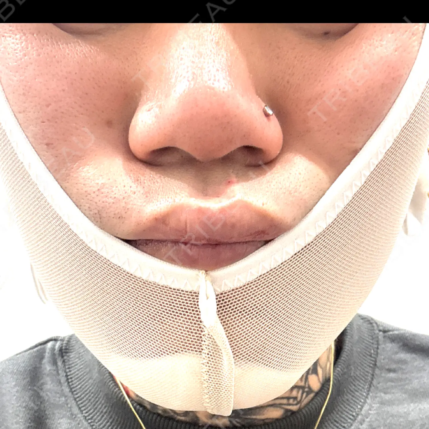 施術前の写真