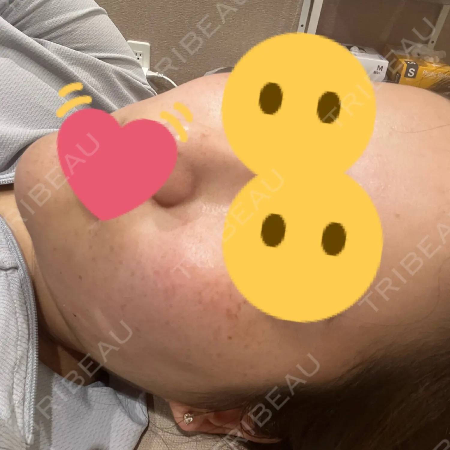 施術前の写真
