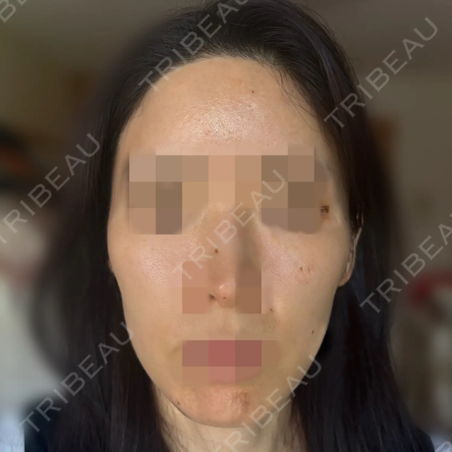 施術前の写真