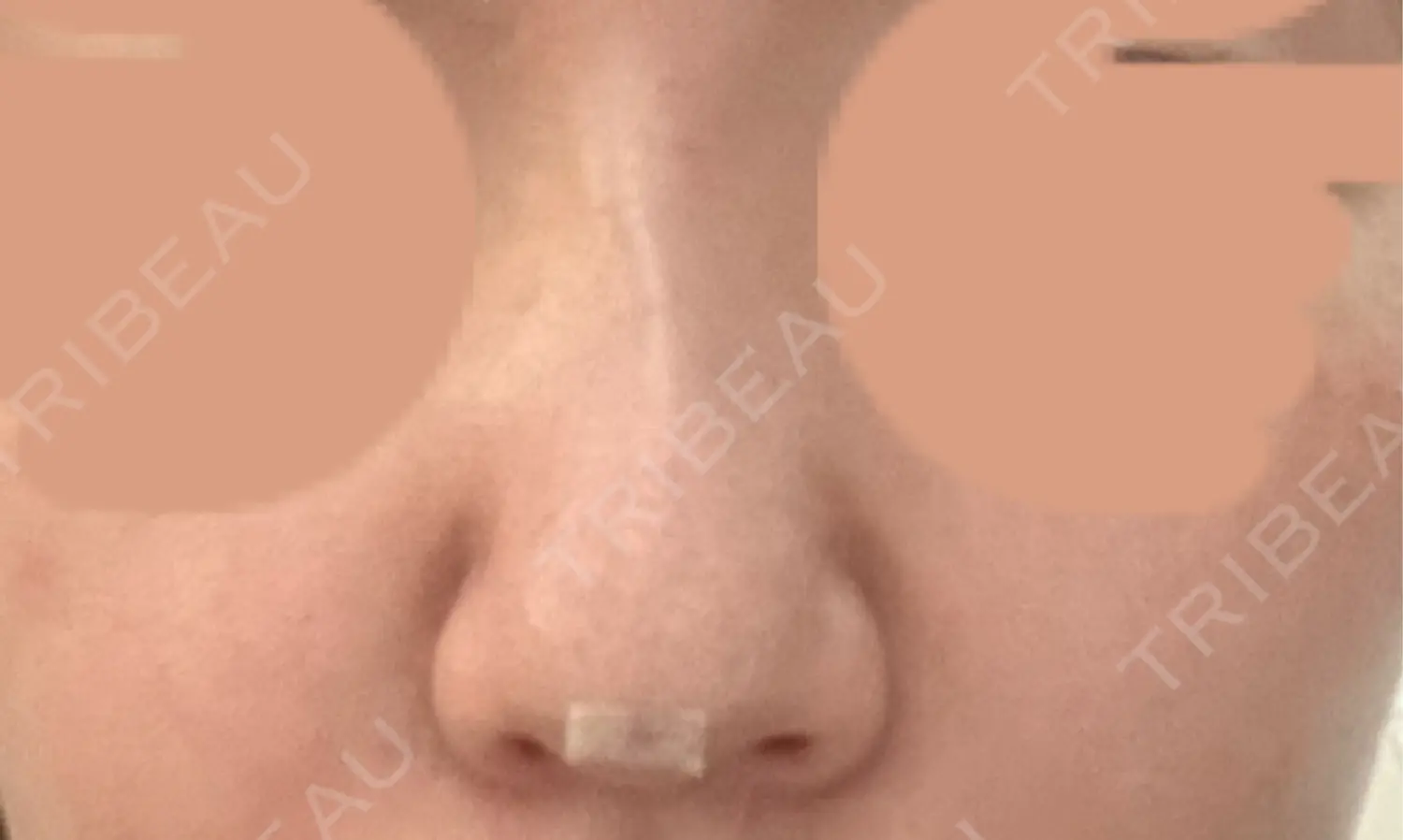 施術前の写真