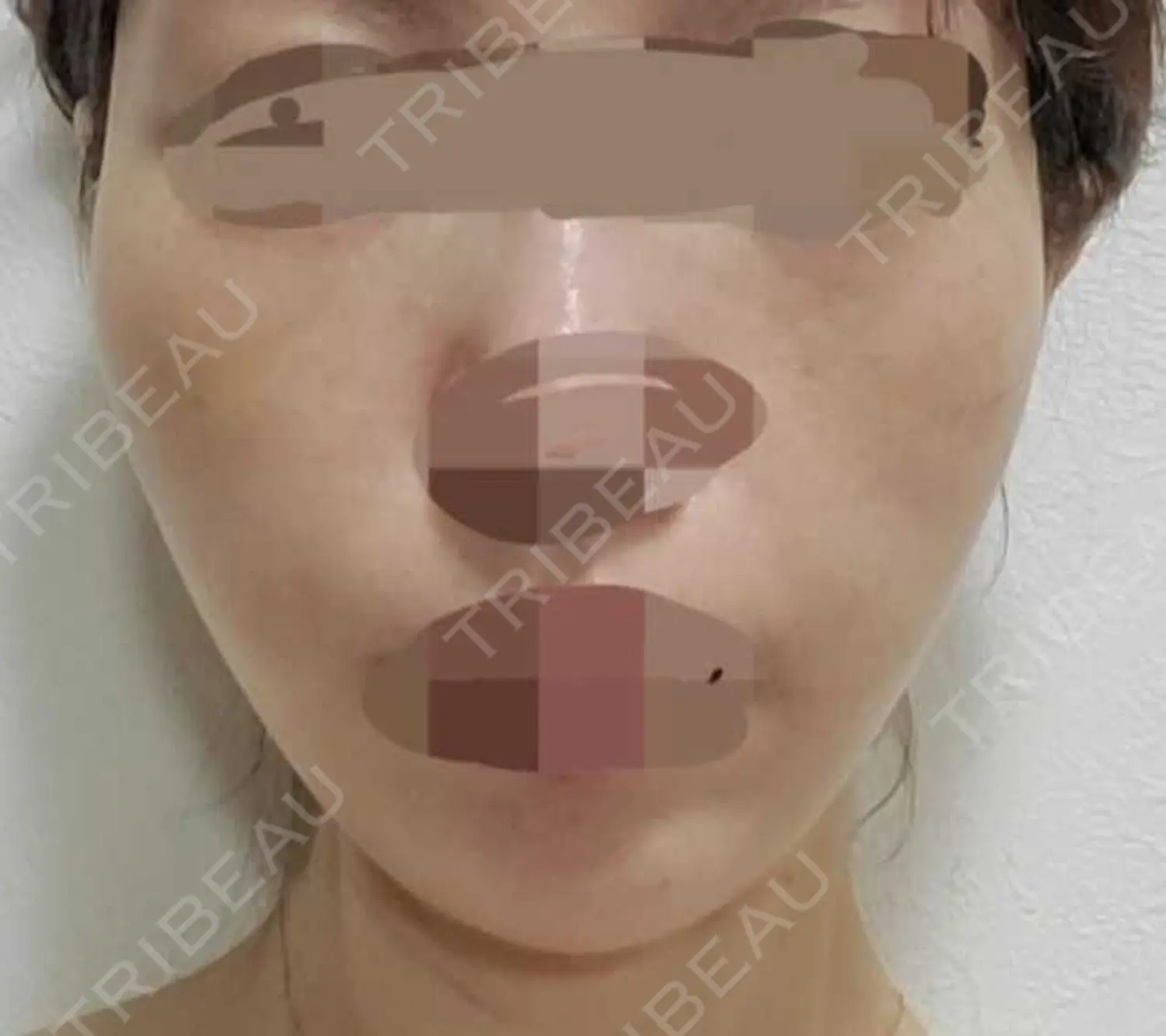 施術前の写真